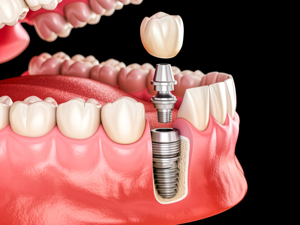A 3D model of All-on-4 Dental Implants