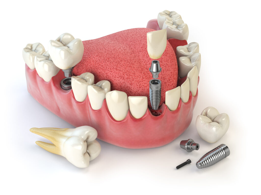 A 3D model of All-on-6 Dental Implants